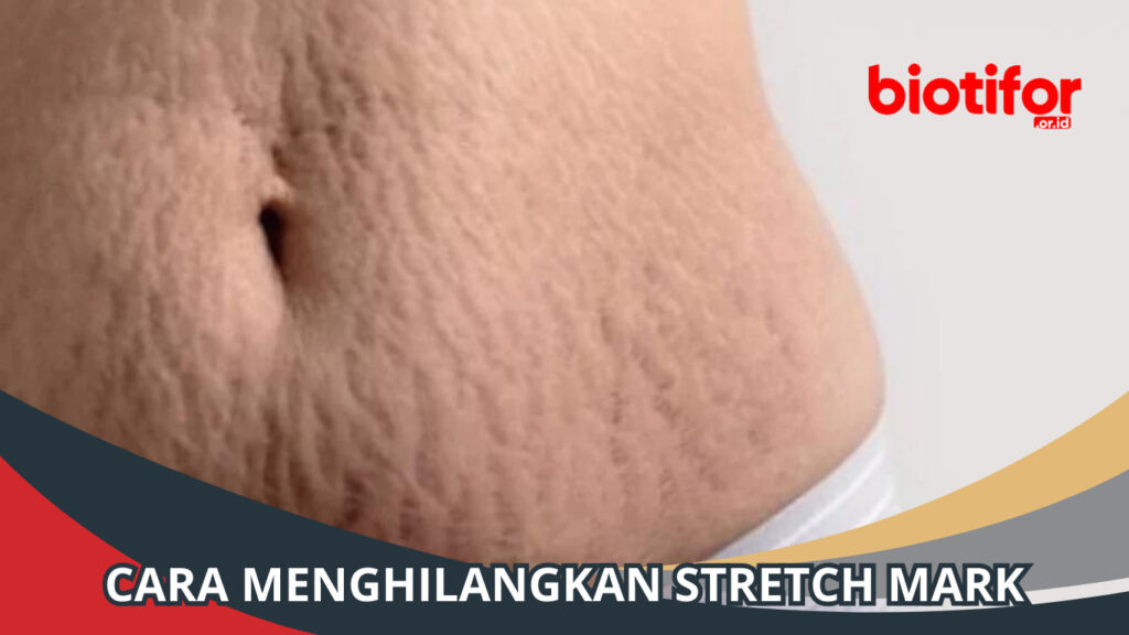 Cara Menghilangkan Stretch Mark Tips Untuk Kulit Lebih Halus Biotifor