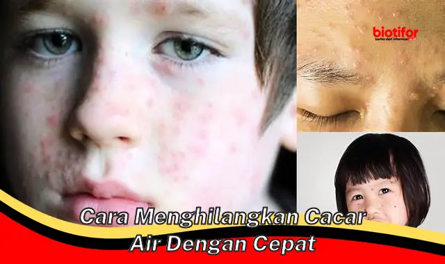 Panduan Lengkap: Cara Menghilangkan Cacar Air dengan Cepat dan Efektif