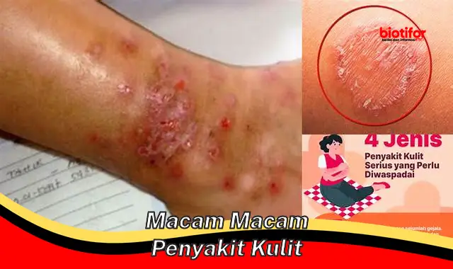 Kenali Berbagai Macam Penyakit Kulit dan Cara Mengatasinya