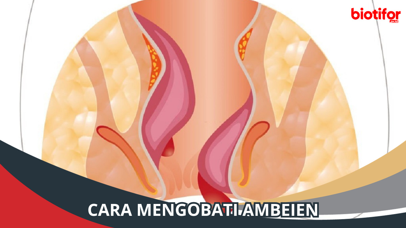 Cara Mengobati Ambeien | Solusi Ampuh untuk Mengatasinya