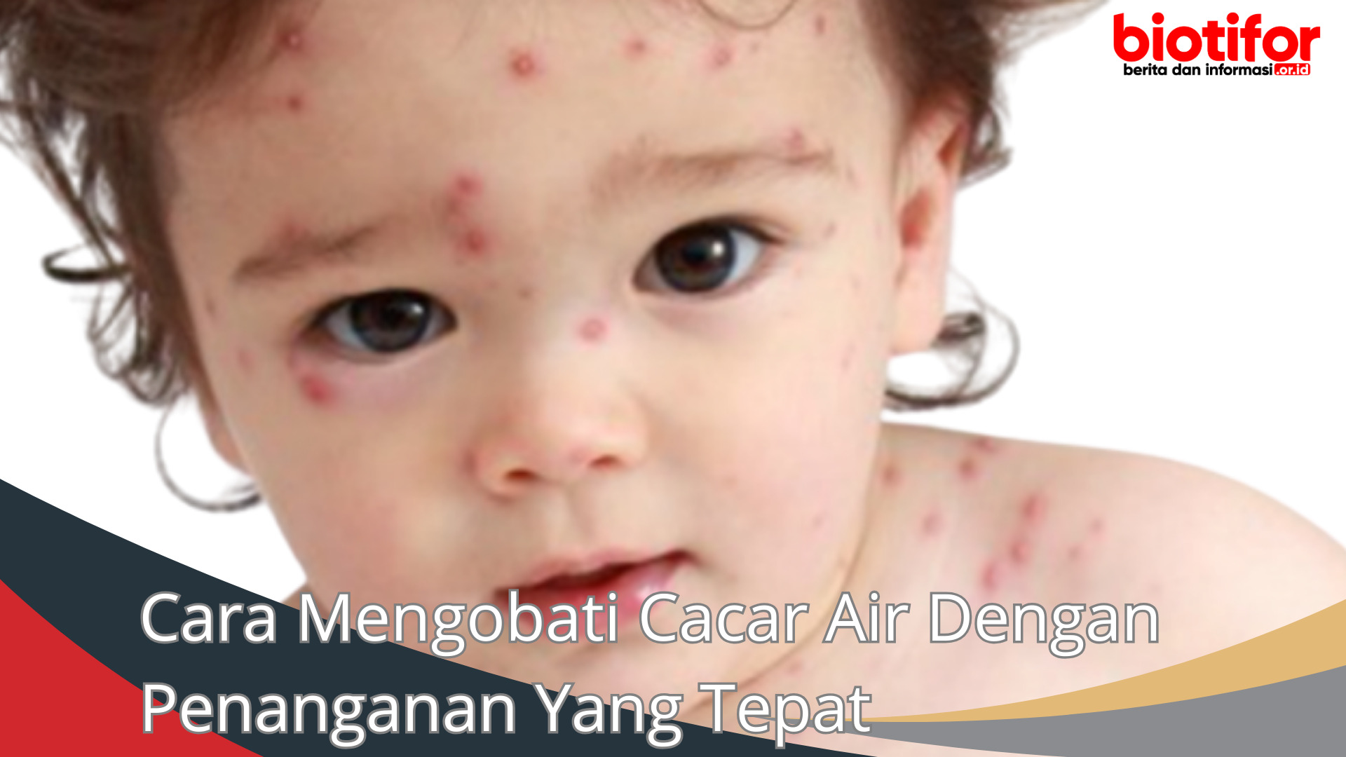 Cara Mengobati Cacar Air Dengan Penanganan Yang Tepat