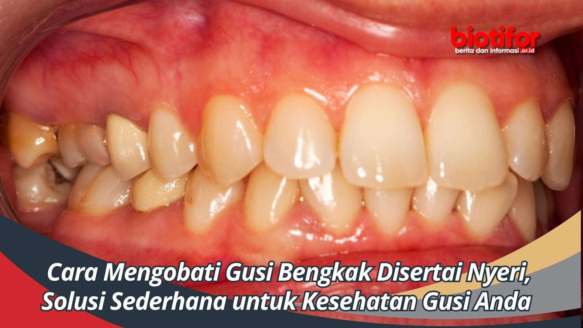 Cara Mengobati Gusi Bengkak Disertai Nyeri, Solusi Sederhana untuk Kesehatan Gusi Anda