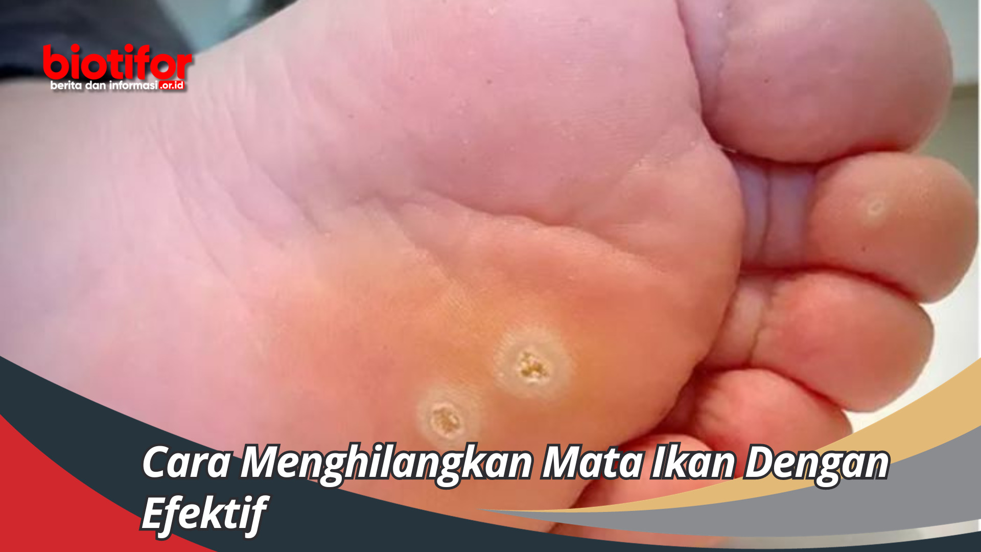 Cara Menghilangkan Mata Ikan Dengan Efektif Dan Cepat Hilang