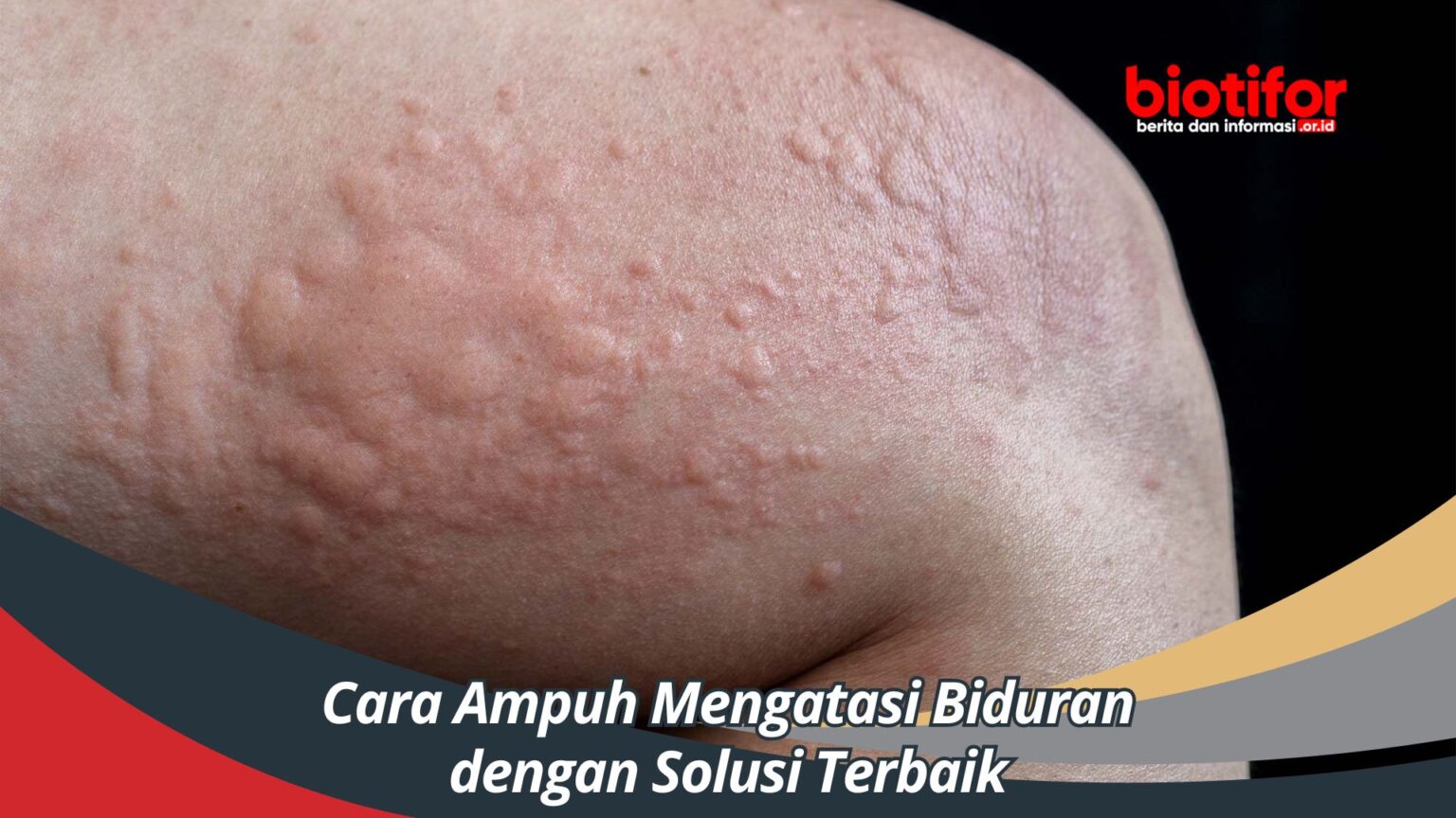 Cara Ampuh Mengatasi Biduran Dengan Solusi Terbaik Biotifor