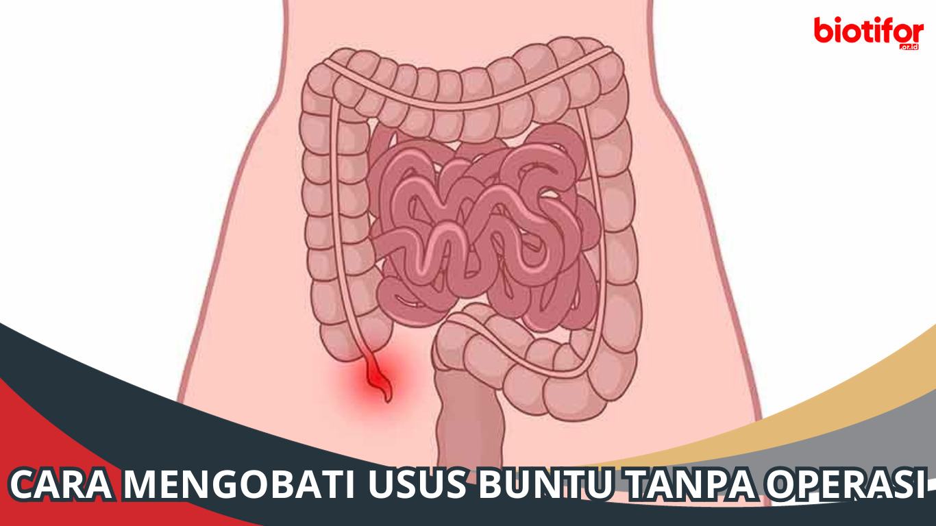 Cara Mengobati Usus Buntu Tanpa Operasi