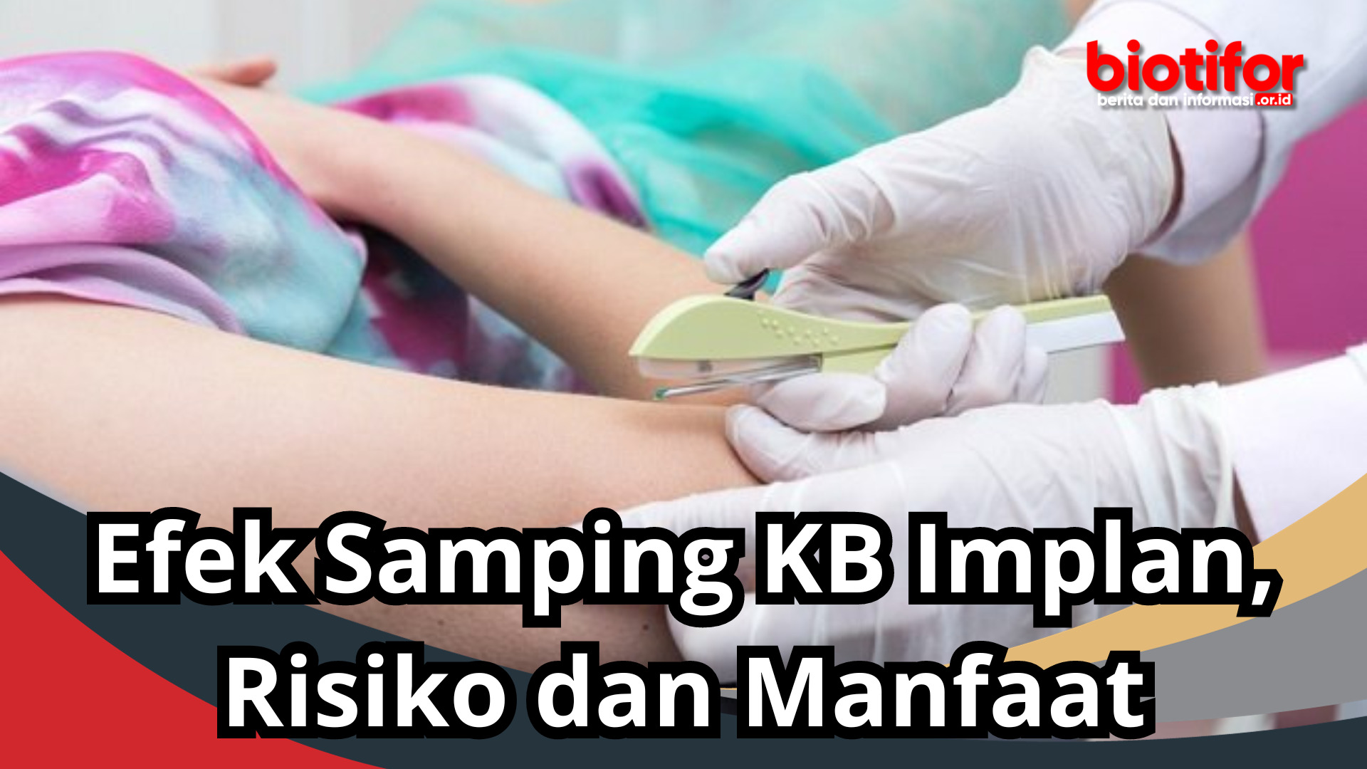 Efek Samping KB Implan, Risiko dan Manfaat