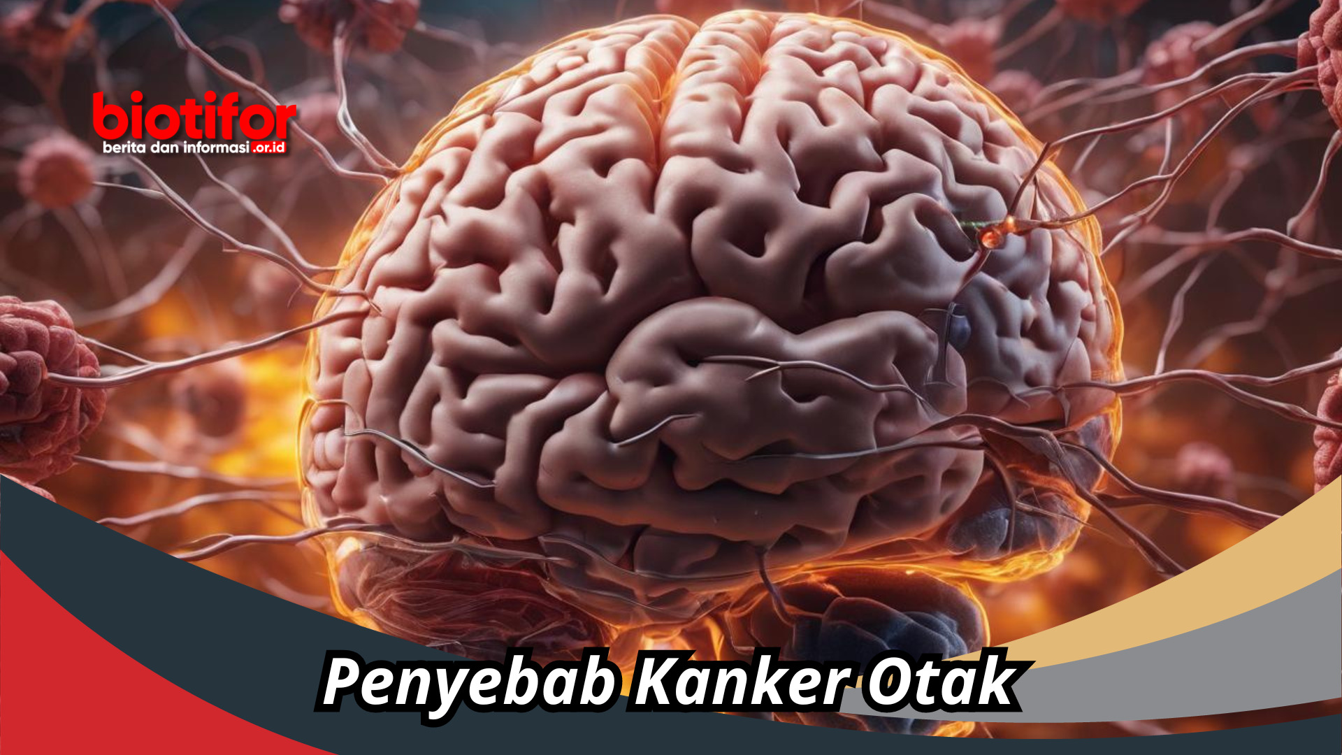 Penyebab Kanker Otak : Ancaman Yang Perlu Diwaspadai